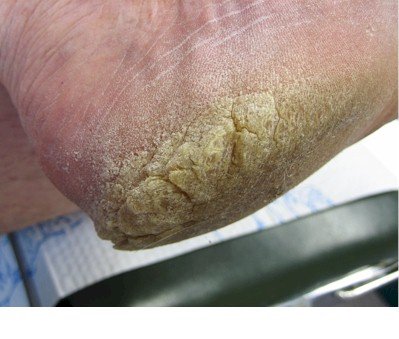 Cracked Heel Treatment - Tips & Advice - Pain Relief ...