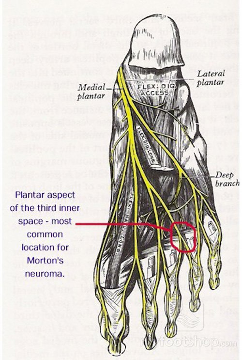 anatomy of Morton's neuroma