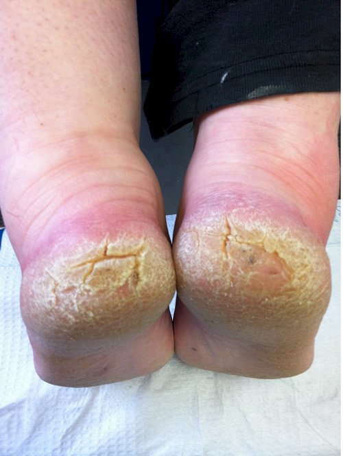Heel Fissures » Identify Your Foot Pain - walkEZstore.com