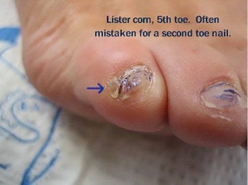 corn on toe pictures #10