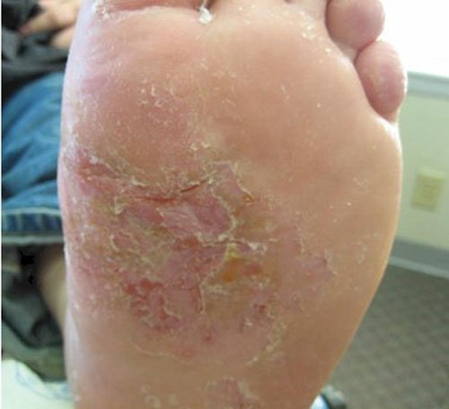 Athlete's Foot Picture Image on MedicineNet.com