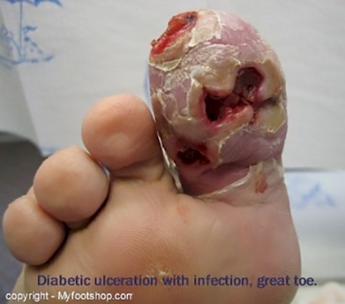 Diabetic Foot Ulcers: Pathogenesis and Management ...