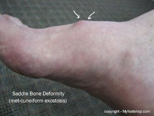 Common Foot Problems – WebMD