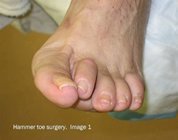 Hammer_toe_surgery_image1
