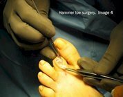 Hammer_toe_surgery_image4