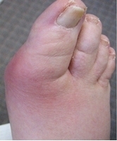 Gout | Causes and treatment options Myfootshop.com