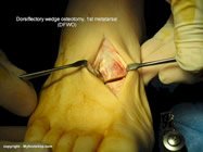 Dorsiflectory wedge osteotomy of the first metatarsal