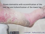 stasis_dermatitis_leg