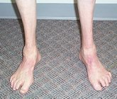 Charcot-Marie_Tooth_Disease
