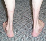 Charcot-Marie_Tooth_Disease