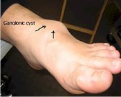 Ganglionic cyst of the foot
