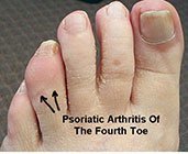 psoriatic arthritis of the toe