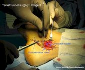 Tarsal tunnel release surgery