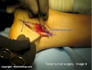 Tarsal tunnel surgery