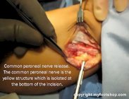 diabetic_peripheral_nerve_surgery_common_peroneal_nerve