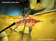surgical_denervation_sural_nerve