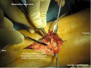 surgical_denervation_sural_nerve