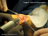 hallux limitus surgery
