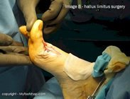 Hallux limitus surgery