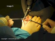 Hallux_rigidus_surgery_image5