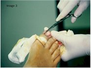 Ingrown_toe_nail_surgery_image3