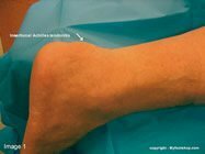 Achilles_tendonitis_surgery