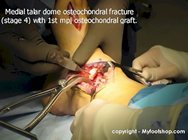 talar_dome_fracture_surgery