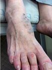 varicosity of the foot