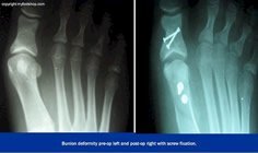 bunion_x-ray_pre-op_and_post-op