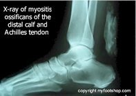 myosits_ossificans_x-ray_ankle