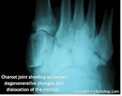 Charcot_joint_post-op_x-ray