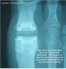 Great_toe_implant_x-ray