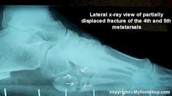 Metatarsal_fracture