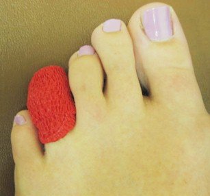 Broken Toes Causes And Treatment Options Myfootshop
