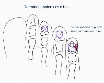 Terminal phalanx as a hat (Lister corns)