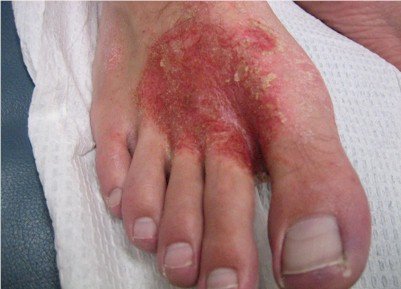 superficial cellulitis of the foot