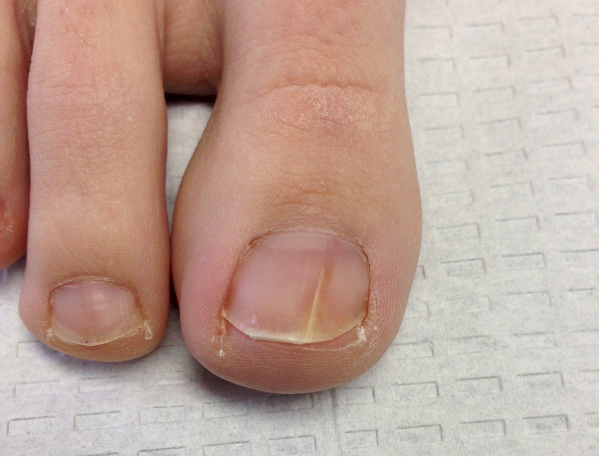 Topical Antifungal Medications | Which medication is right for your toe  nail fungus? 