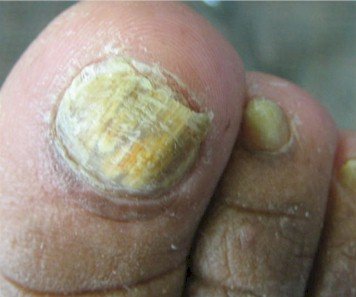 toe nail fungus