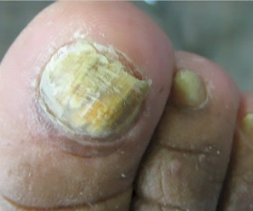 Late stage onychomycosis