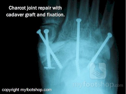 x-ray Charcot joint