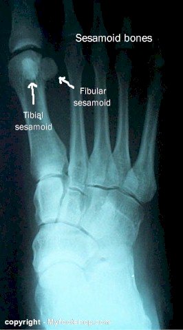 sesamoid bones of the foot