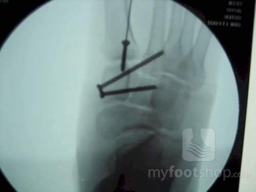Closed reduction Lisfranc fracture