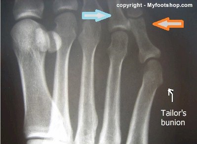 X-ray tailor's bunion