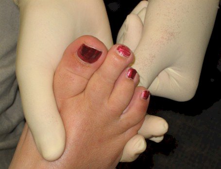 Muldier's sign for Morton's neuroma
