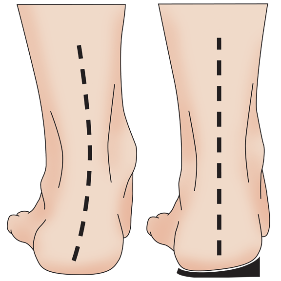 1/4" Thick Lateral Sole Wedge Inserts