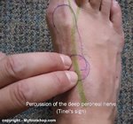 Tinel's_sign_deep_peroneal_nerve