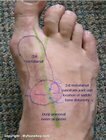 Tinel's_sign_deep_peroneal_nerve