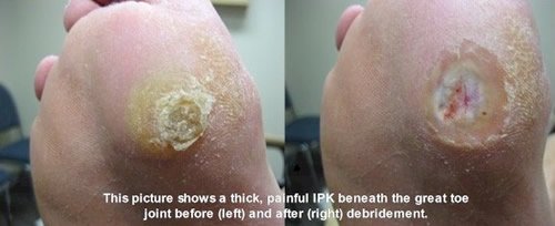 toe box dermatitis