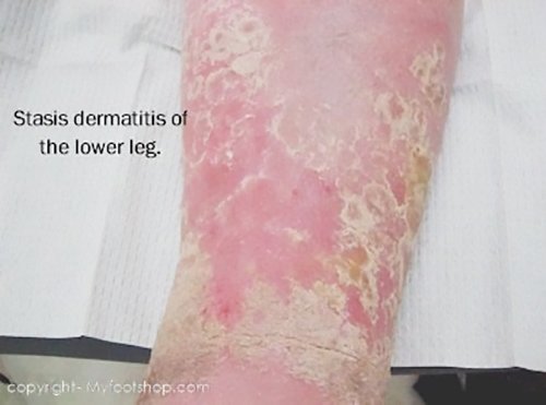 Skin Peeling Between Toes | Med-Health.net