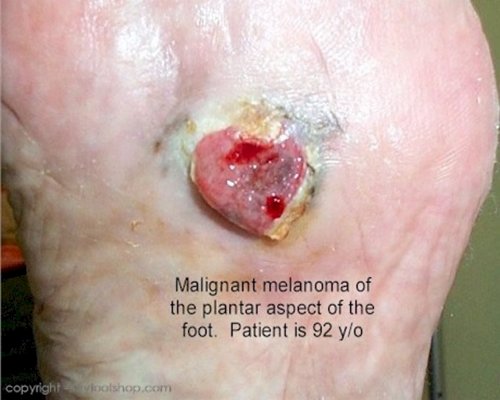 Are toe calluses cancerous?